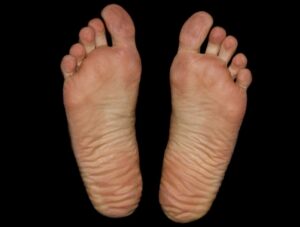 Foot Pain In Seniors