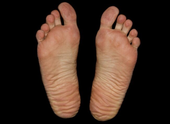 Foot Pain In Seniors