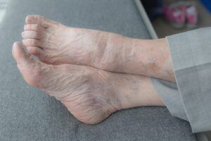 Foot Problems and Diabetes
