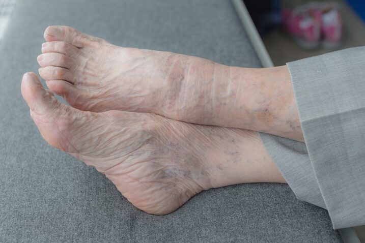 Senior sitting with crossed legs and feet - Foot Problems and Diabetes