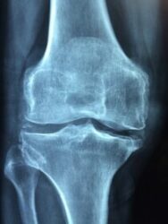 Knee joint bones