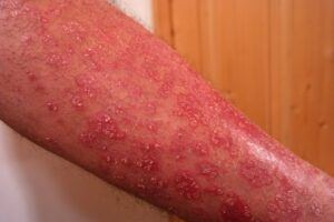 An arm affected by psoriasis - Why is arthritis painful 