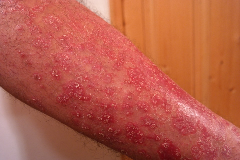 An arm affected by psoriasis