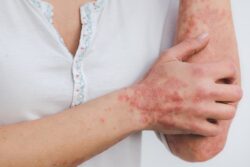 Arthritic Psoriasis Affecting the Hand and Elbow - Why is arthritis painful