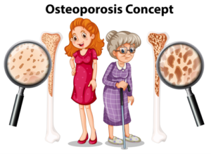 A comparison of the thigh bone structure of a young girl and an elderly woman for osteoporosis