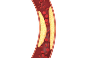 Blood vessel with accumulation of fatty deposits narrowing the flow of blood cells