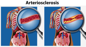 Human anatomy with arteriosclerosis