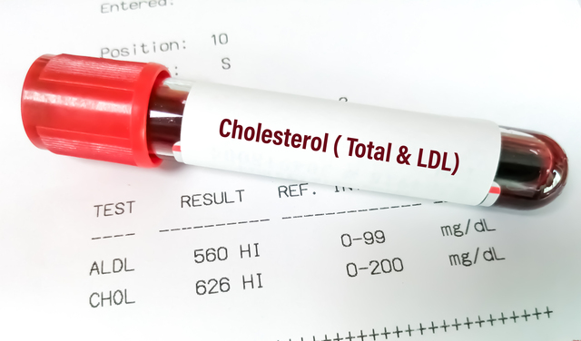 Blood sample with-repot of cholesterol -total-and-ldl-cholesterol - Early Signs of High Cholesterol