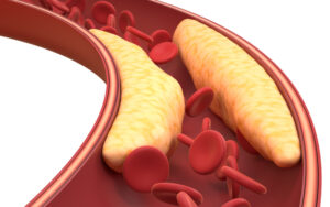 heart-health-plaque-deposits-impedes-movement-of-blood-cells-in-the-artery - Early Signs of High Cholesterol