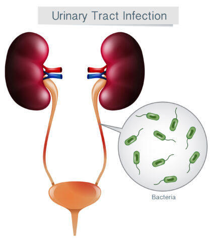 Urinary Tract Infection on White Background - 7 Ways to Conquer Urinary Tract Infections in Older Adults